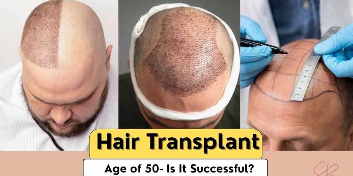 Hair Transplant in Your 50s: Results, Risks, and Realities