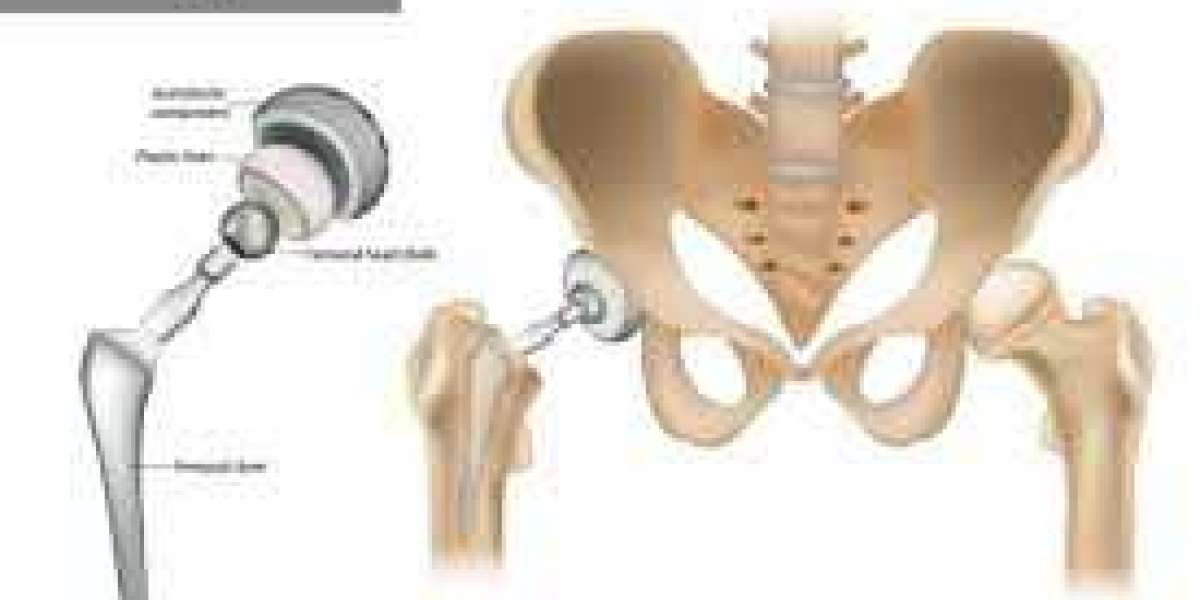 Private Spine Surgery Canada