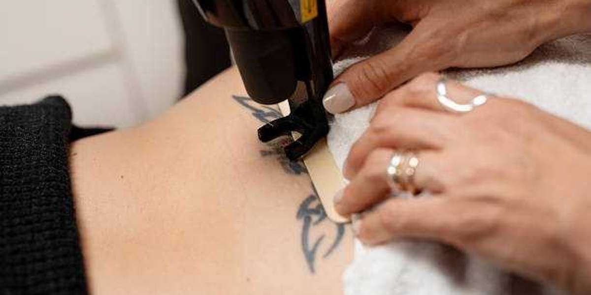 How Long Should You Wait Between Laser Tattoo Removal Sessions?