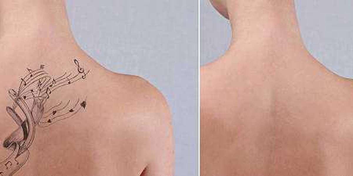Tattoo Removal Treatment Options in Riyadh