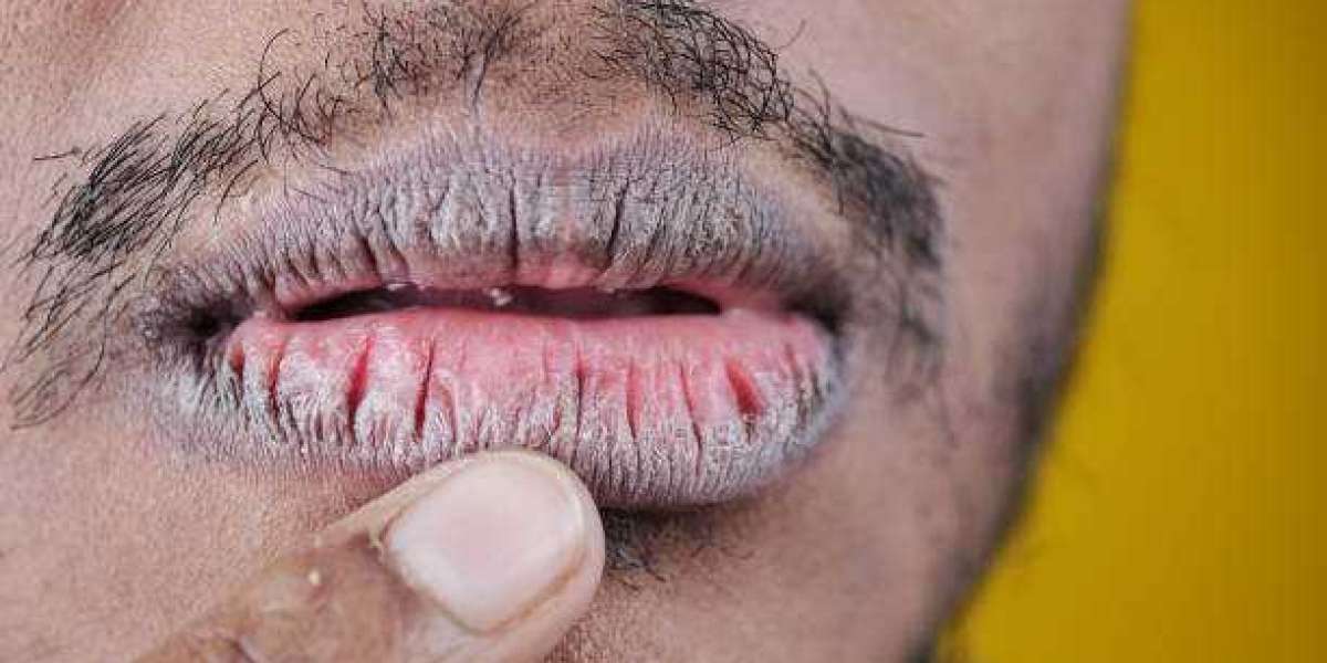 Treatment Options for Fine Lines Around the Mouth