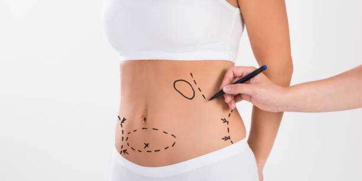 Understanding Advanced Liposuction in Riyadh for Body Shape Refinement