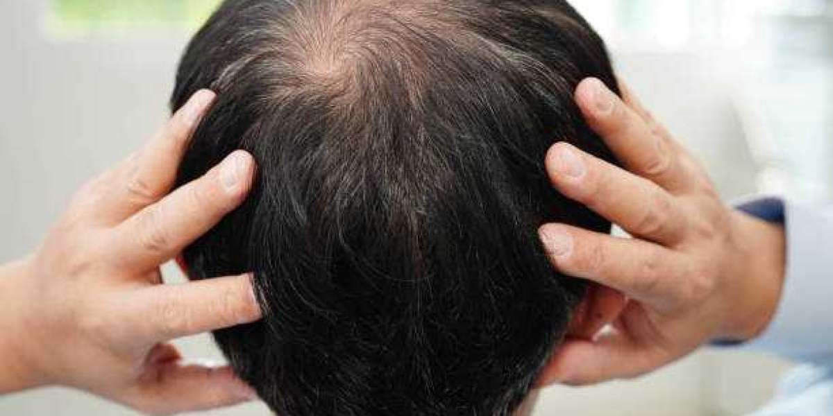 A Complete Guide to Non-Surgical Hair Loss Treatment Options