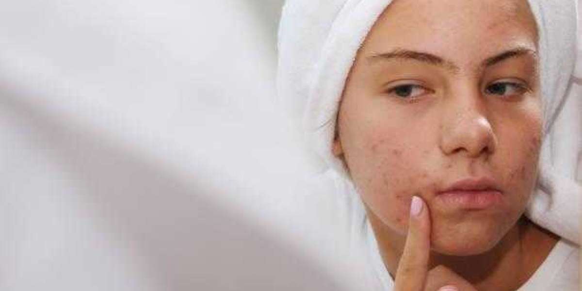 Common Acne Treatment Mistakes to Avoid