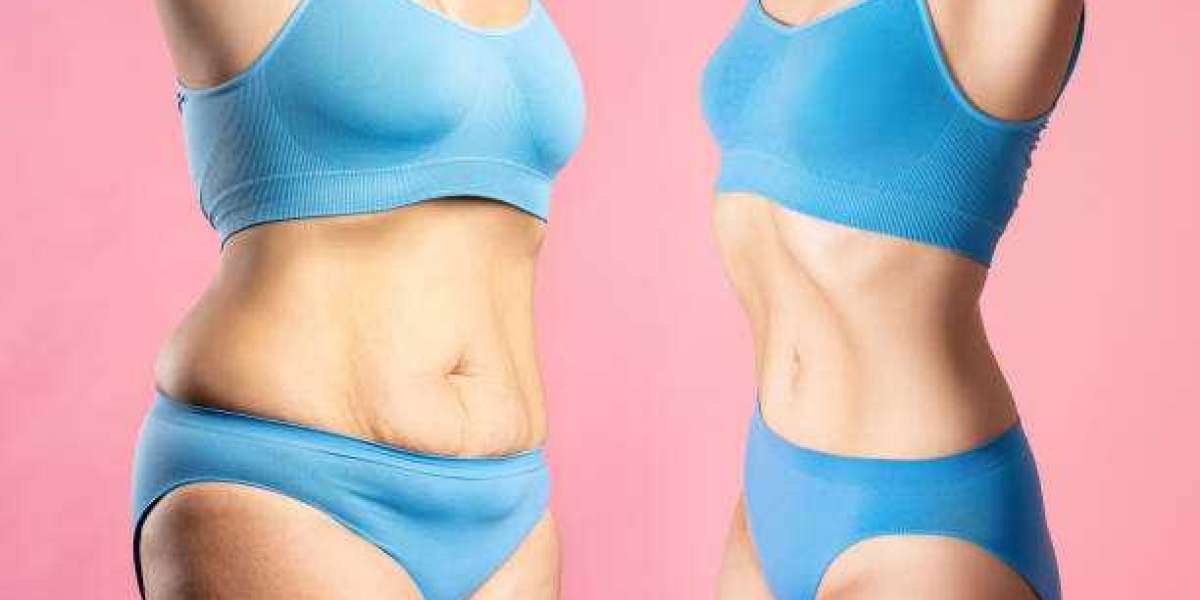 Preparing for Tummy Tuck Surgery in Riyadh: A Complete Patient Guide