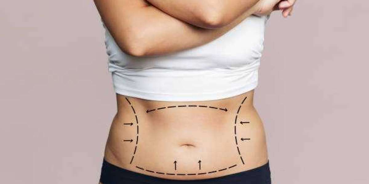 How Consultation Helps Plan Liposuction in Riyadh