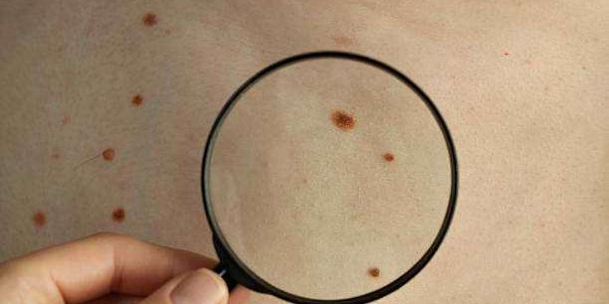 Common Reasons People Consider Mole Removal