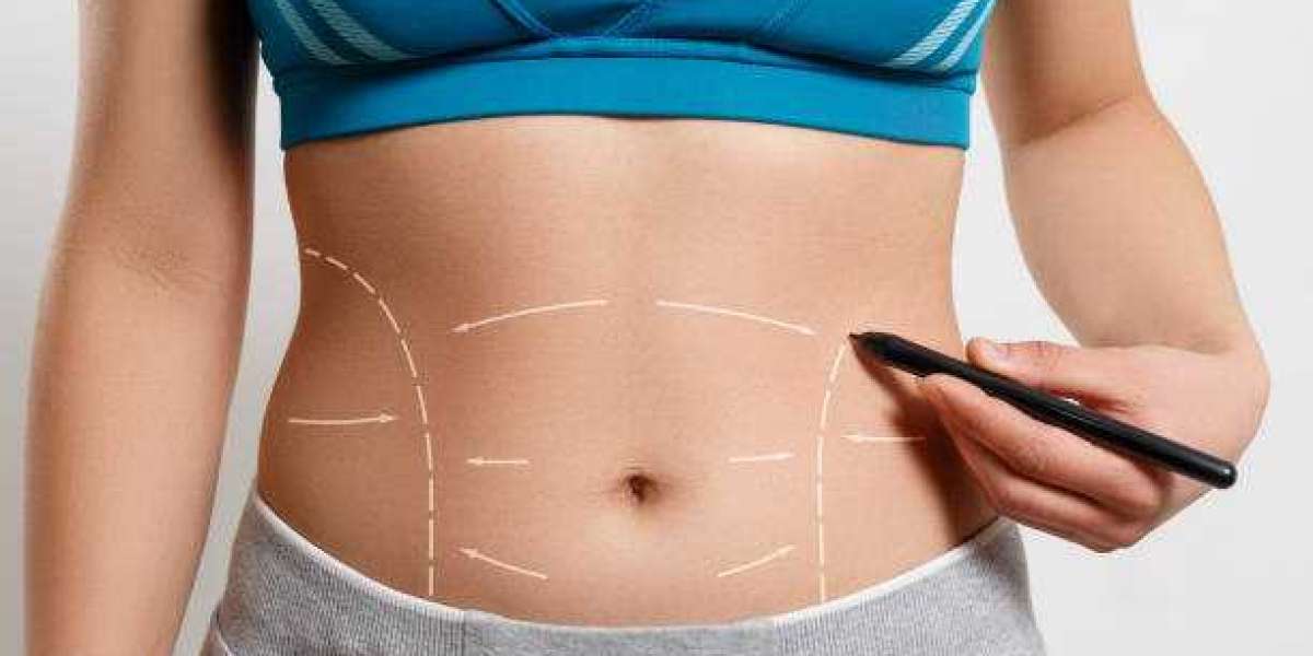 Liposuction in Riyadh: Surgical Techniques Explained