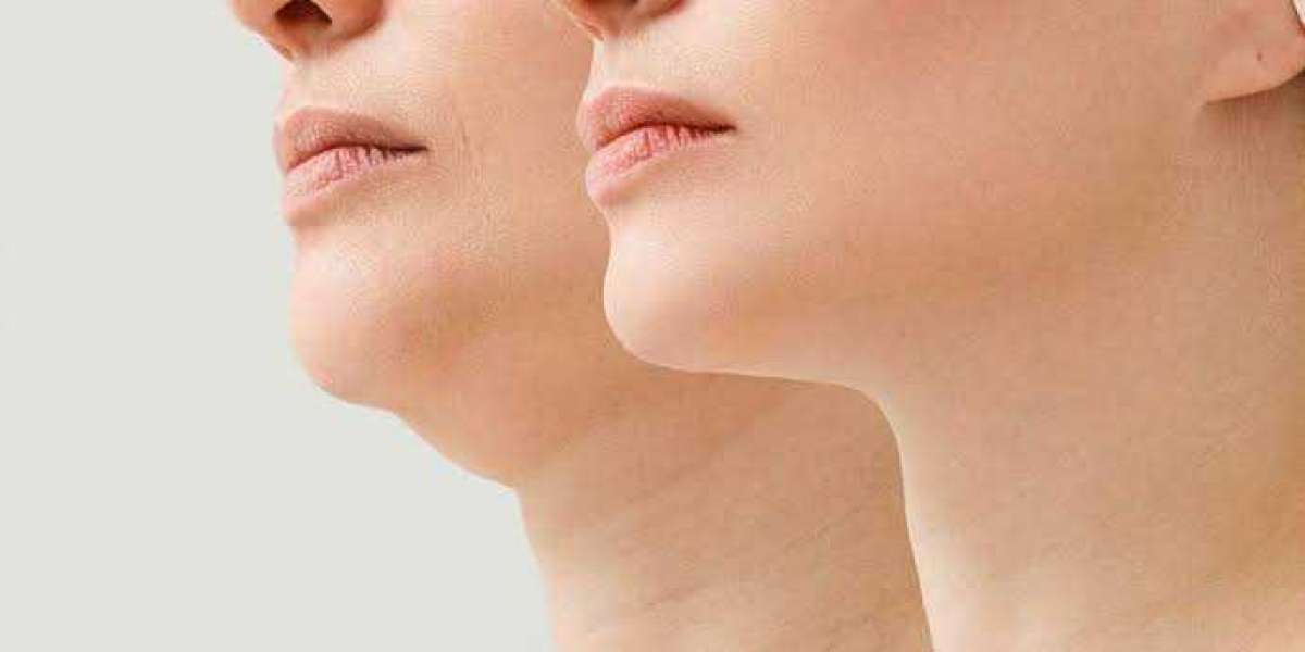 Understanding Advanced Double Chin Liposuction in Riyadh for Jawlines