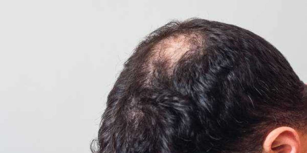 Is Alopecia Areata Treatment Different for Adults and Children?
